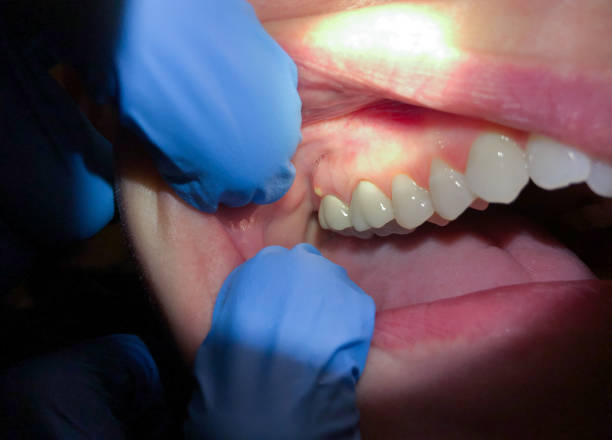 Best Emergency Dentist for Knocked-Out Tooth in Grayslake, IL